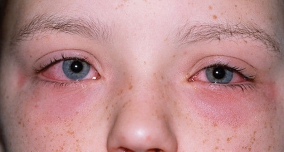 vörös viszkető foltok a szem körül Golyuk pikkelysömör kezelésének módszere