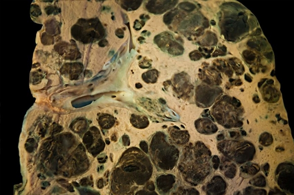 Metastases of melanoma in liver isolated on black (Forrás: 123rf)