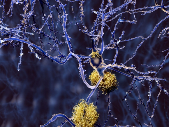 Alzheimer disease, neurons with amyloid plaques (Forrás: 123rf)