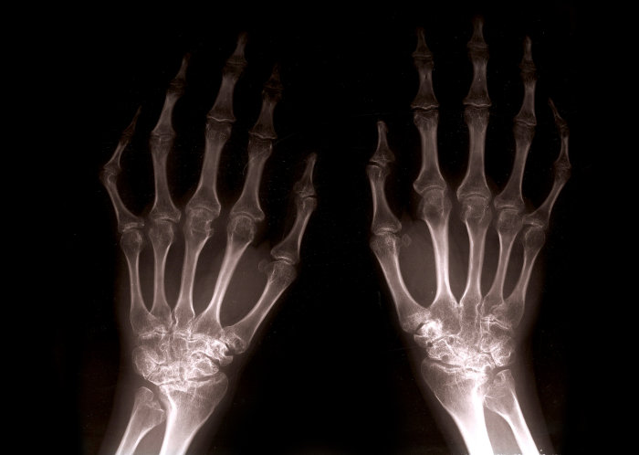 hogyan és hogyan lehet az artritisz kezelésére