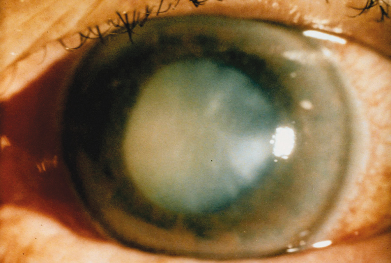 előrelépés a szemészetben a szaruhártya leukorrhoea kezelésében