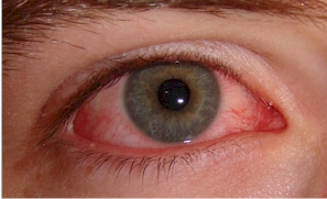 vörös szem kontaktlencse
