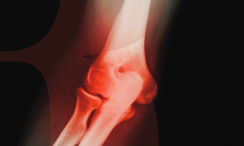 fájdalomcsillapítás a vállízület osteoarthritisében